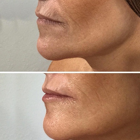 Before and after Juvederm