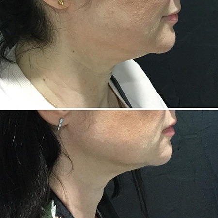 Before and after double chin treatment