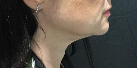 Closeup of results after double chin treatment