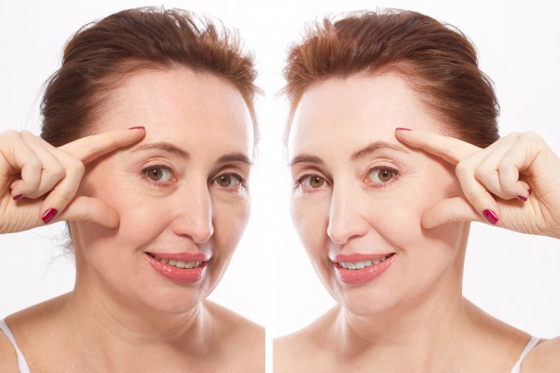 The before and after images of an older woman who recently received dermal fillers