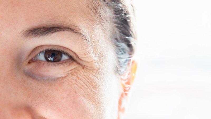 an up-close view of a patient’s crow’s feet